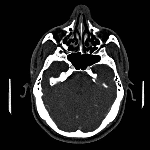 Acute basilar artery occlusion (Radiopaedia 43582-46985 Axial C+ arterial phase 59).jpg