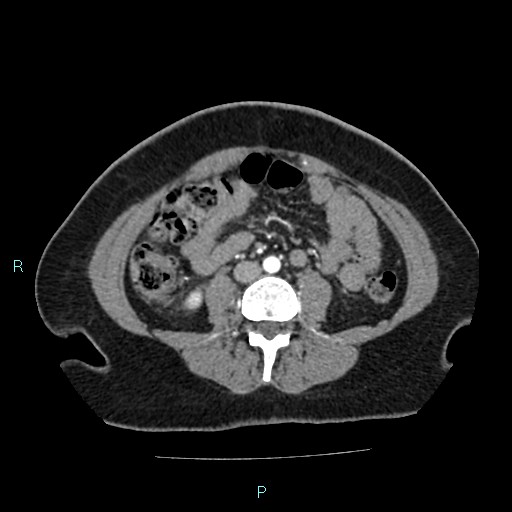 Acute bilateral pyelonephritis (Radiopaedia 37146-38881 Axial C+ arterial phase 112).jpg