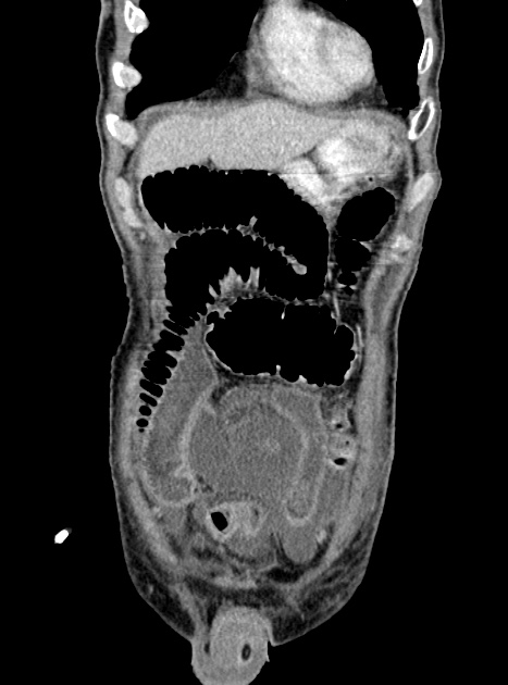 Acute bowel ischemia (Radiopaedia 87695-104114 Coronal C+ portal venous phase 106).jpg