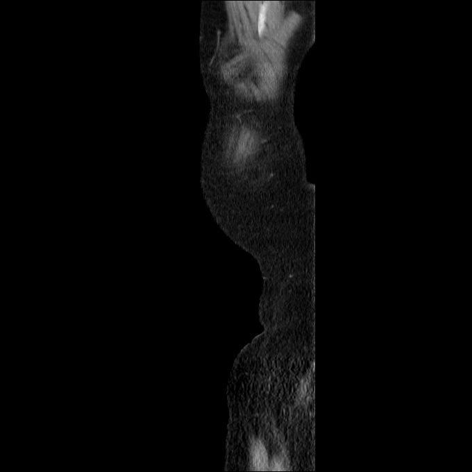 Acute cholecystitis and incidental left sided IVC (Radiopaedia 49352-54459 Sagittal C+ portal venous phase 4).jpg