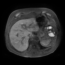 Acute cholecystitis complicated by pylephlebitis (Radiopaedia 65782-74915 Axial T1 fat sat 21).jpg