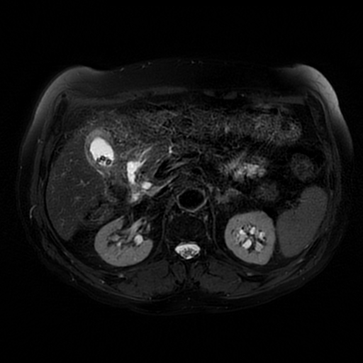 File:Acute cholecystitis complicated by pylephlebitis (Radiopaedia 65782-74915 Axial T2 fat sat 24).jpg