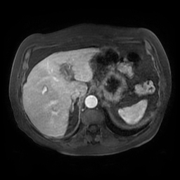 Acute cholecystitis complicated by pylephlebitis (Radiopaedia 65782-74915 Axial arterioportal phase T1 C+ fat sat 33).jpg