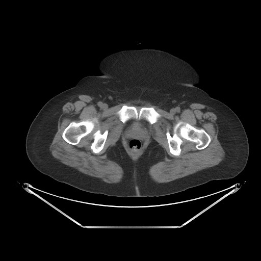 File:Acute cholecystitis with tensile fundus sign (Radiopaedia 71394-81723 Axial non-contrast 119).jpg