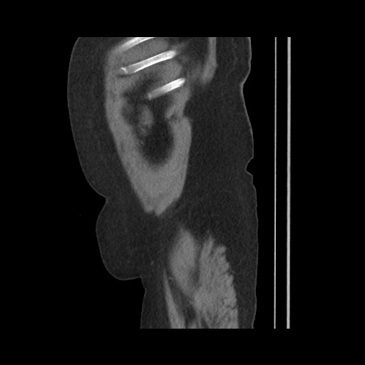 Acute cholecystitis with tensile fundus sign (Radiopaedia 71394-81723 Sagittal non-contrast 149).jpg