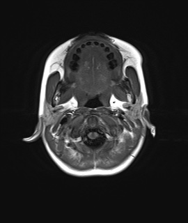 File:Acute disseminating encephalomyelitis with bilateral optic neuritis (Radiopaedia 79676-92886 Axial T1 1).jpg
