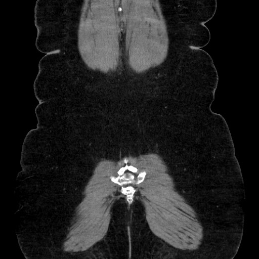 Acute diverticulitis - transverse colon (Radiopaedia 87063-103327 Coronal C+ portal venous phase 144).jpg