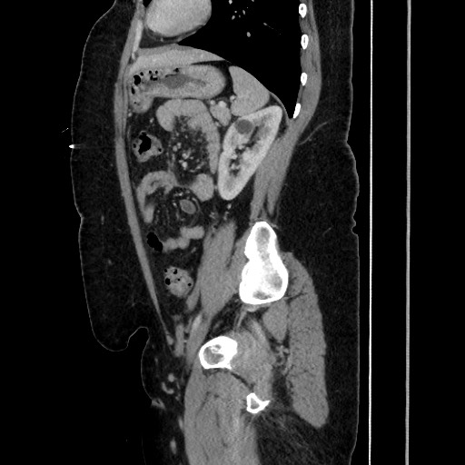 Acute diverticulitis - transverse colon (Radiopaedia 87063-103327 Sagittal C+ portal venous phase 154).jpg