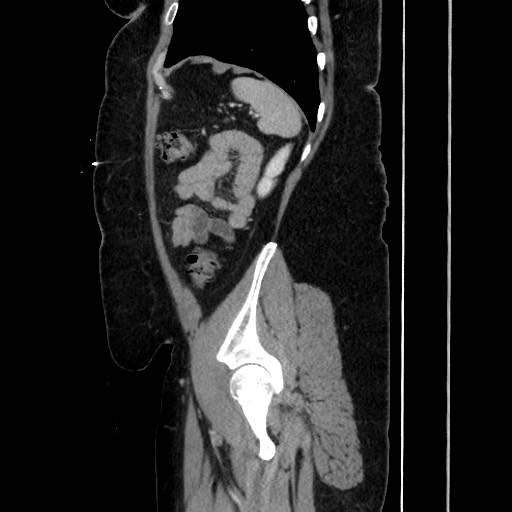 Acute diverticulitis - transverse colon (Radiopaedia 87063-103327 Sagittal C+ portal venous phase 172).jpg
