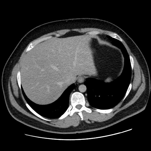 Acute diverticulitis with localized perforation (Radiopaedia 41296-44113 Axial C+ portal venous phase 15).jpg