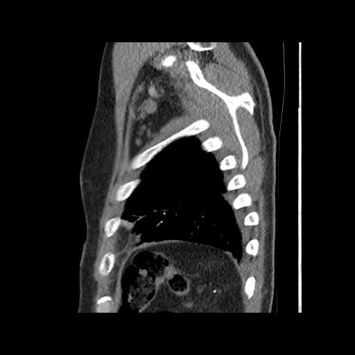 Acute epicardial fat necrosis (Radiopaedia 42327-45440 Sagittal C+ CTPA 61).jpg