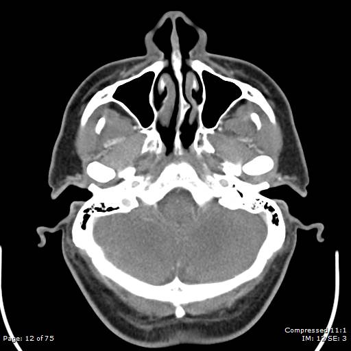 File:Acute epiglottitis (Radiopaedia 54375-60590 Axial C+ arterial phase 12).jpg