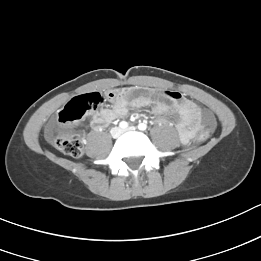 Acute gangrenous appendicitis with perforation (Radiopaedia 40152-42662 Axial C+ portal venous phase 43).png