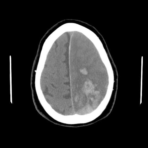 Acute hemorrhagic stroke (Radiopaedia 17507-17223 Axial non-contrast 42).jpg