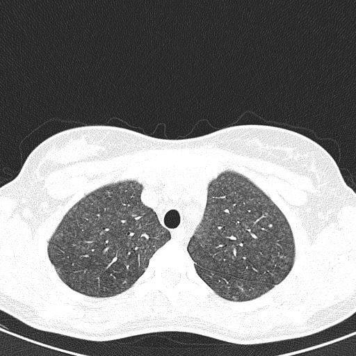 File:Acute hypersensitivity pneumonitis (Radiopaedia 85293-100870 Axial lung window 23).jpg