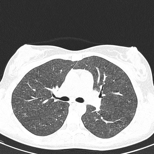 File:Acute hypersensitivity pneumonitis (Radiopaedia 85293-100870 Axial lung window 46).jpg
