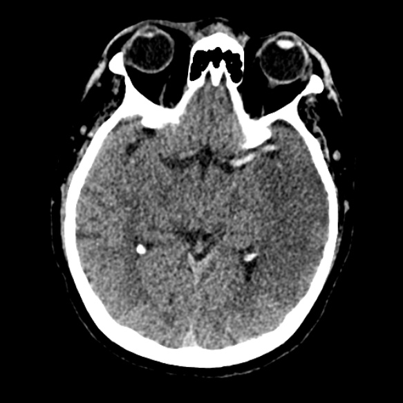 Acute middle cerebral artery territory infarct (Radiopaedia 52380-58283 Axial non-contrast 44).jpg