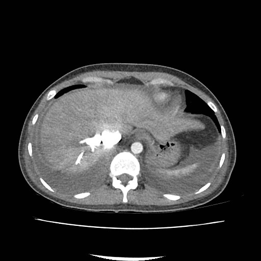 File:Acute myocarditis (Radiopaedia 55988-62613 Axial C+ portal venous phase 11).jpg