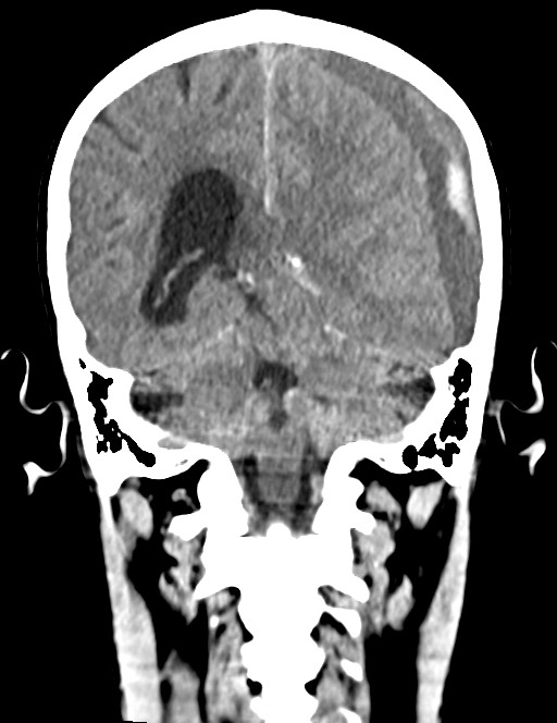 Acute on chronic subdural hematoma (Radiopaedia 74814-85823 Coronal non-contrast 43).jpg
