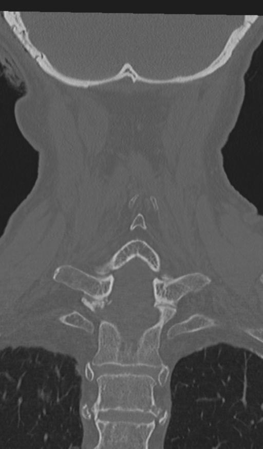 Acute on chronic subdural hematoma and thoracic vertebral injury in a multitrauma patient (Radiopaedia 31698-32619 Coronal bone window 49).jpg