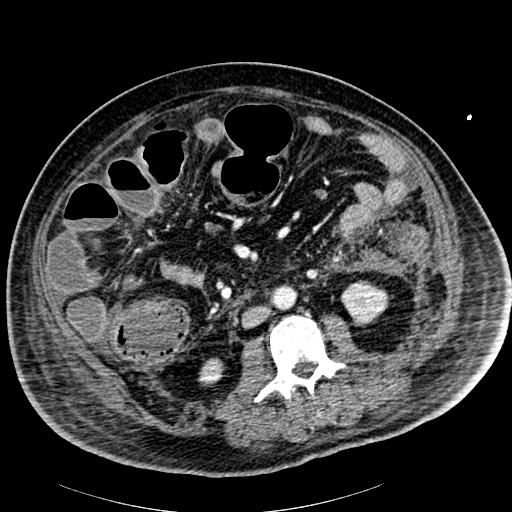 Acute pancreatic necrosis (Radiopaedia 13560-18502 Axial C+ portal venous phase 56).jpg