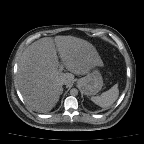 Acute pancreatitis (Radiopaedia 26663-26813 Axial non-contrast 23).jpg