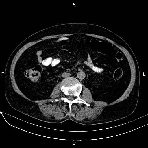File:Acute pancreatitis (Radiopaedia 85146-100701 Axial non-contrast 69).jpg