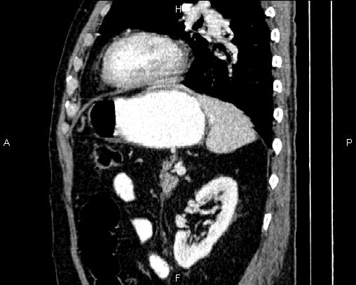 Acute pancreatitis (Radiopaedia 85146-100701 Sagittal C+ portal venous phase 67).jpg