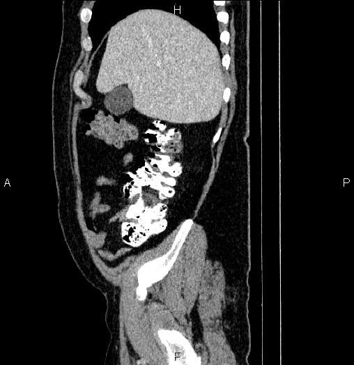 Acute pancreatitis (Radiopaedia 85390-101010 Sagittal C+ portal venous phase 15).jpg
