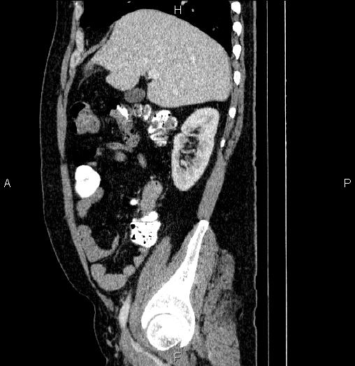 File:Acute pancreatitis (Radiopaedia 85390-101010 Sagittal C+ portal venous phase 26).jpg