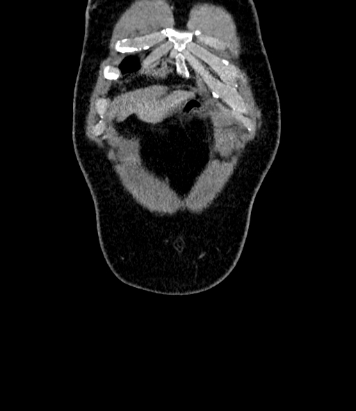 Acute pancreatitis (Radiopaedia 87428-103757 Coronal C+ portal venous phase 6).jpg