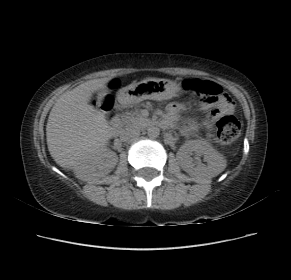 File:Acute pancreatitis - Balthazar E - post ERCP (Radiopaedia 27562-27772 Axial non-contrast 23).png