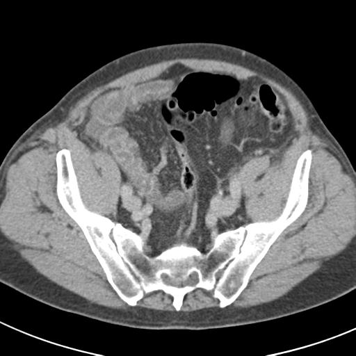 Acute pancreatitis and walled-off necrosis (Radiopaedia 29888-30403 Axial C+ delayed 67).jpg
