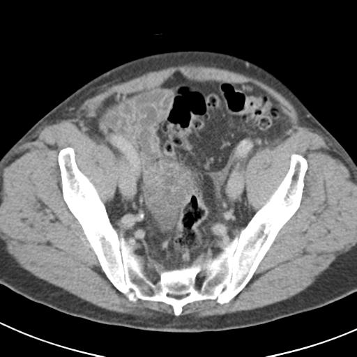 Acute pancreatitis and walled-off necrosis (Radiopaedia 29888-30403 Axial C+ delayed 70).jpg