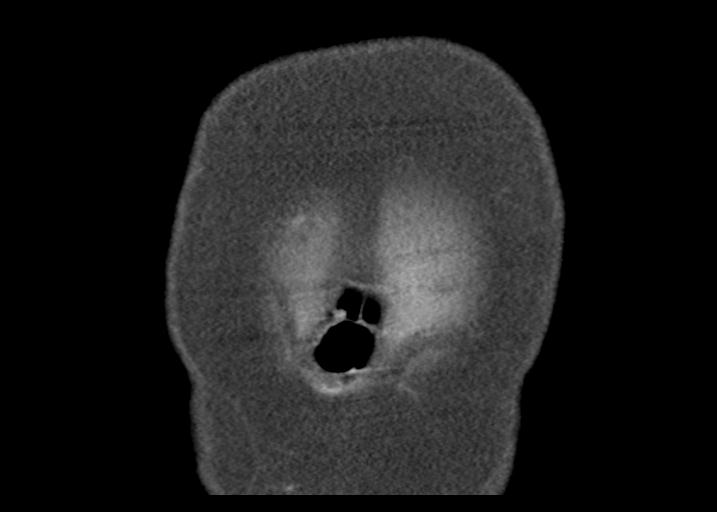 Acute pancreatitis and walled-off necrosis (Radiopaedia 29888-30403 Coronal C+ portal venous phase 6).jpg