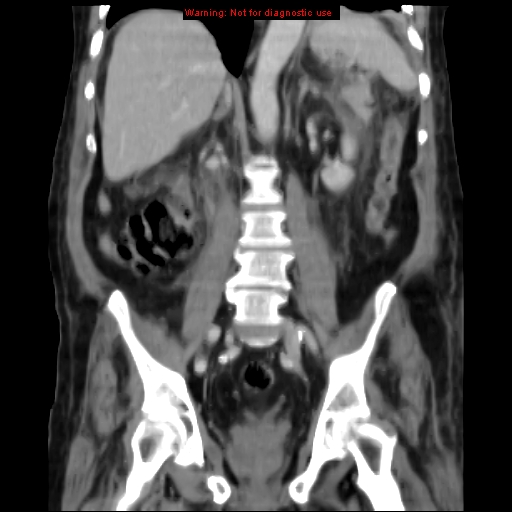Acute pancreatitis with incidental pancreatic lipoma (Radiopaedia 10190-10730 Coronal C+ portal venous phase 44).jpg