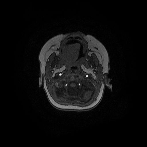 Acute phase of hemiconvulsion-hemiplegia epilepsy syndrome (Radiopaedia 29309-29745 Axial TOF angiography 155).jpg