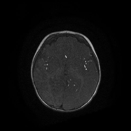 Acute phase of hemiconvulsion-hemiplegia epilepsy syndrome (Radiopaedia 29309-29745 Axial TOF angiography 60).jpg