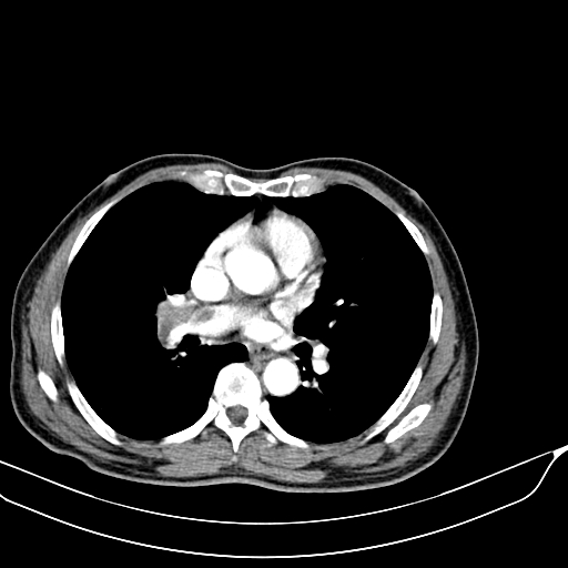 File:Acute pulmonary embolism (Radiopaedia 69510-79390 D 21).jpg