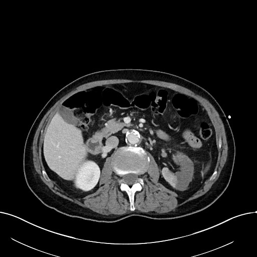 Acute renal infarction (Radiopaedia 59375-66736 Axial C+ portal venous phase 40).jpg
