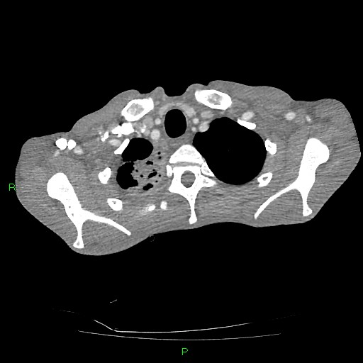 File:Acute right lung abscess (Radiopaedia 34806-36258 Axial C+ arterial phase 17).jpg