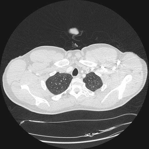Acute segmental pulmonary emboli and pulmonary infarction (Radiopaedia 62264-70444 Axial lung window 15).jpg