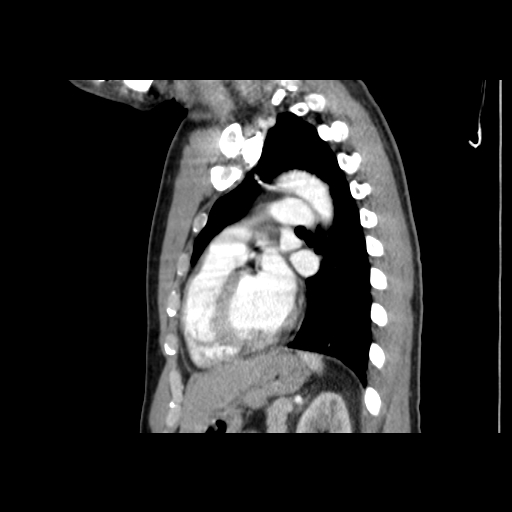 Acute segmental pulmonary emboli and pulmonary infarction (Radiopaedia 62264-70444 Sagittal C+ CTPA 43).jpg