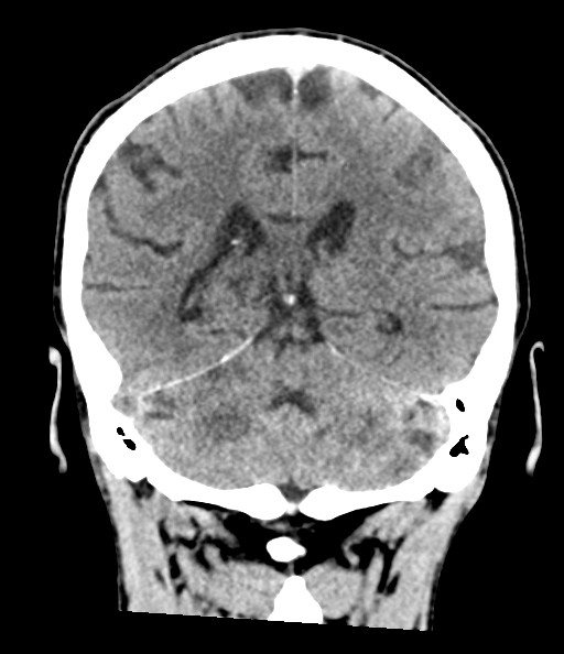 File:Acute superior cerebellar artery territory infarct (Radiopaedia 84104-99359 Coronal non-contrast 60).jpg