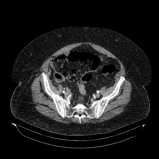 File:Acute superior mesenteric artery occlusion (Radiopaedia 51288-56960 Axial C+ arterial phase 74).jpg