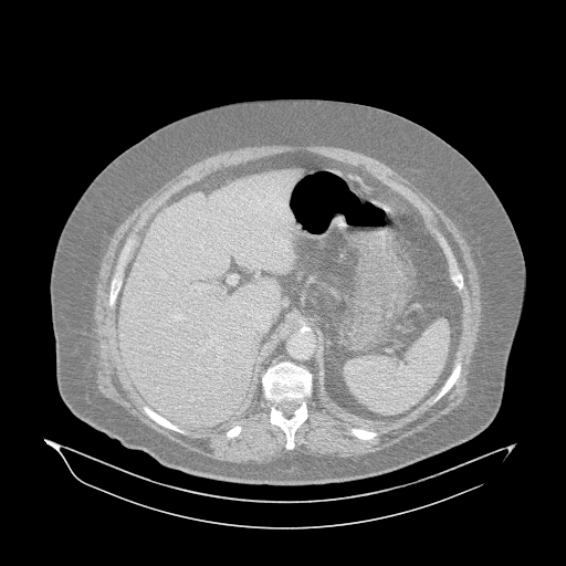 Acute superior mesenteric artery occlusion (Radiopaedia 51288-56960 Axial lung window 6).jpg