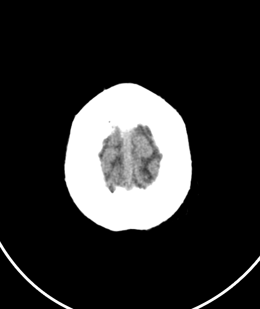 Acute traumatic subdural hematoma (Radiopaedia 82921-97257 Axial non-contrast 11).jpg