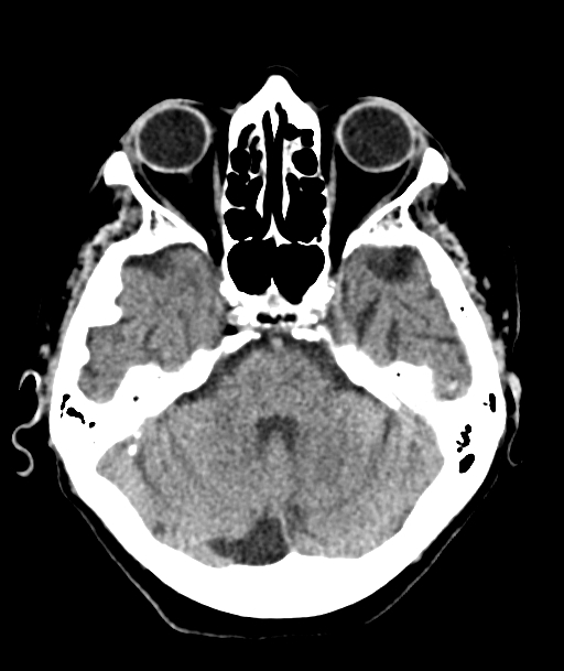Acute traumatic subdural hematoma (Radiopaedia 82921-97257 Axial non-contrast 46).jpg
