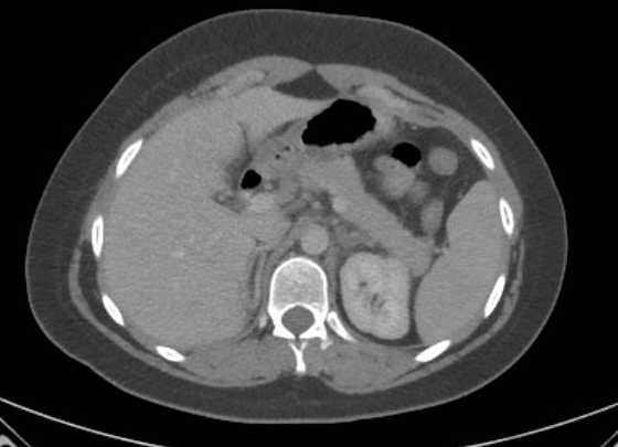 Acute unilateral nonhemorrhagic adrenal infarction (Radiopaedia 67560-76957 Axial renal parenchymal phase 31).jpg