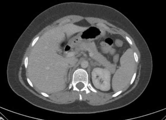 Acute unilateral nonhemorrhagic adrenal infarction (Radiopaedia 67560-76957 Axial renal parenchymal phase 32).jpg